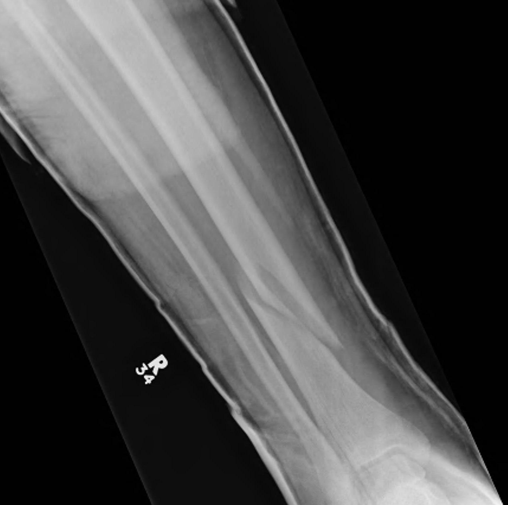 Tibial Shaft Fracture Non Operative Treatment Before